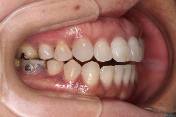 極端な上下前歯の開咬を改善　オープンバイトのインビザライン矯正 治療途中画像