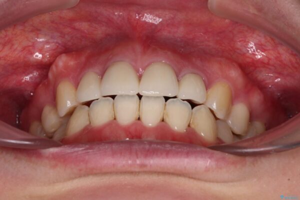 八重歯と開咬を治したい　目立たないハーフリンガル矯正 治療後画像
