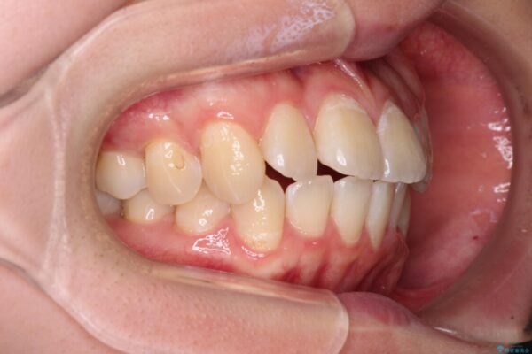 【モニター】八重歯と前歯のクロスバイト　ワイヤーを併用しインビザラインで矯正治療 治療途中画像