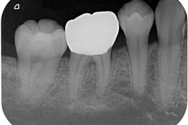 歯が欠けてしみる　オールセラミッククラウンによる虫歯治療 治療後画像