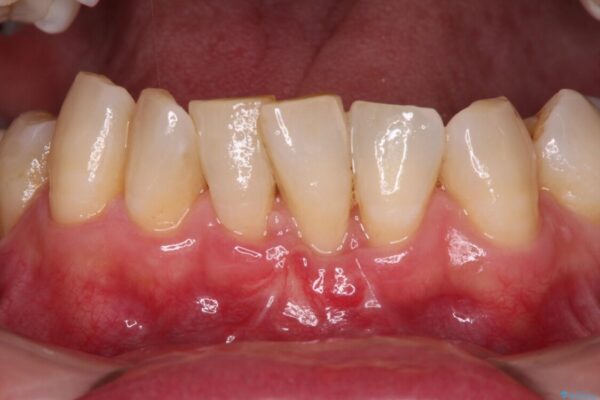 歯根が見えてしみる　歯肉移植による歯肉退縮の改善 治療後画像