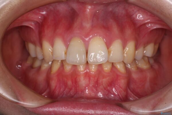 部分矯正を併用した奥歯のインプラント治療 治療後画像