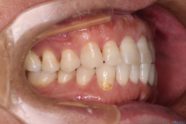 内側にある歯が干渉する　上顎前歯の部分矯正 治療後画像