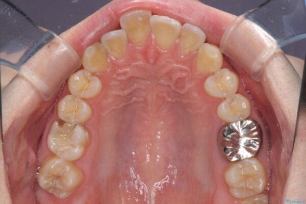 前歯のデコボコを治したい　ワイヤー装置でお手軽に矯正治療 治療前画像