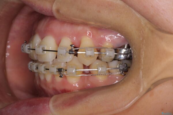 八重歯で口元が膨れている　ワイヤー装置での抜歯矯正 治療途中画像