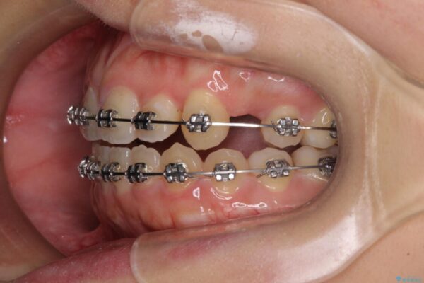 八重歯を抜歯矯正でスッキリと　メタルブラケットでの矯正治療 治療途中画像