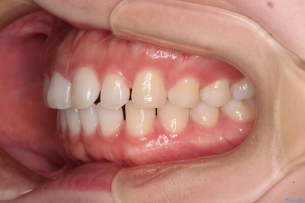 すきっ歯とオープンバイト　インビザライン・ライトで改善 治療前画像