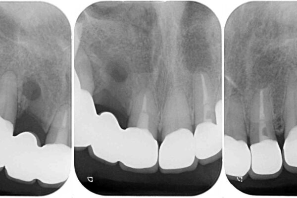治療途中で放置してしまった前歯　オールセラミッククラウンによる補綴治療 治療後画像