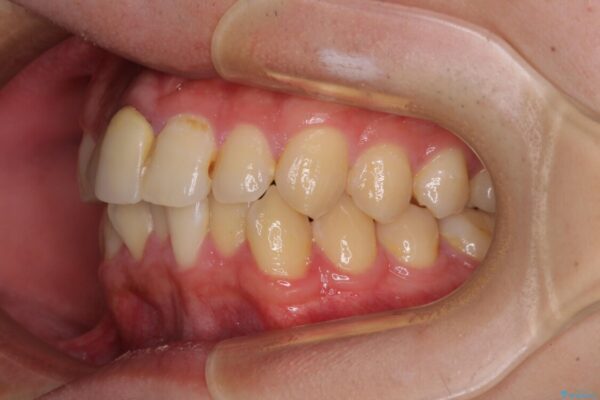 前歯のデコボコを治したい　インビザライン矯正治療 治療前画像