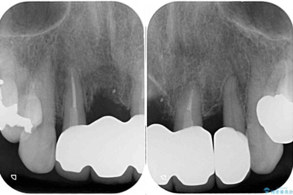 不具合ばかりの前歯　前歯のオールセラミックブリッジ 治療後画像