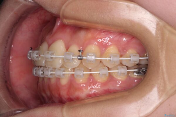 前歯のクロスバイトを短期間で解消　目立たないワイヤー矯正 治療途中画像
