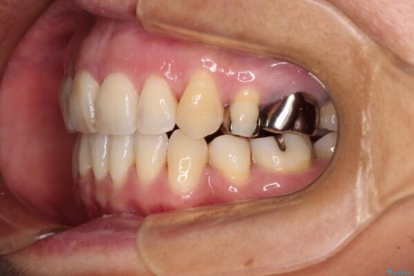 八重歯で口元が膨れている　ワイヤー装置での抜歯矯正 治療後画像