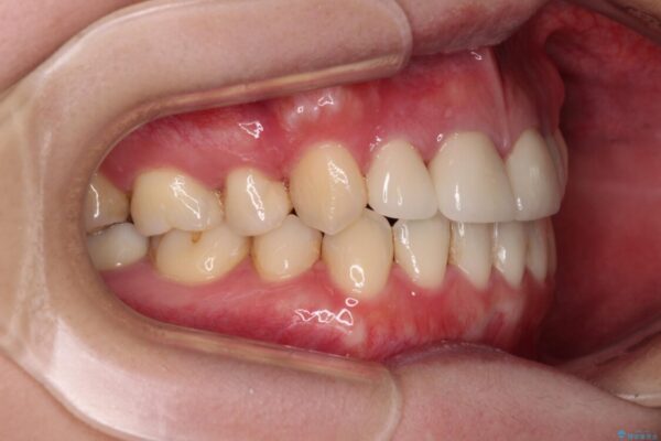 八重歯と開咬を治したい　目立たないハーフリンガル矯正 治療後画像