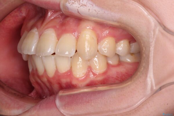 【モニター】八重歯と前歯のクロスバイト　ワイヤーを併用しインビザラインで矯正治療 治療途中画像