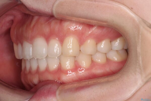 すきっ歯とオープンバイト　インビザライン・ライトで改善 治療途中画像