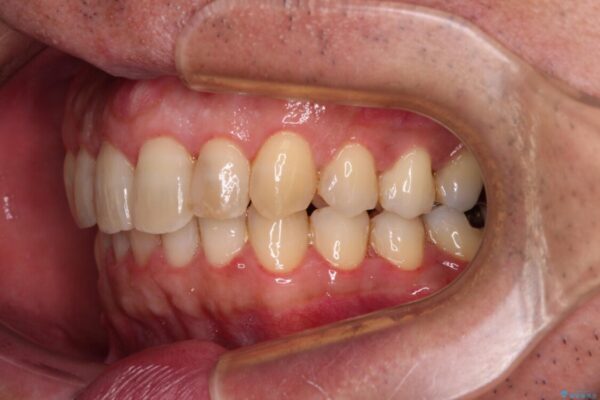 外側に飛び出した歯　インビザラインによる矯正治療 治療後画像