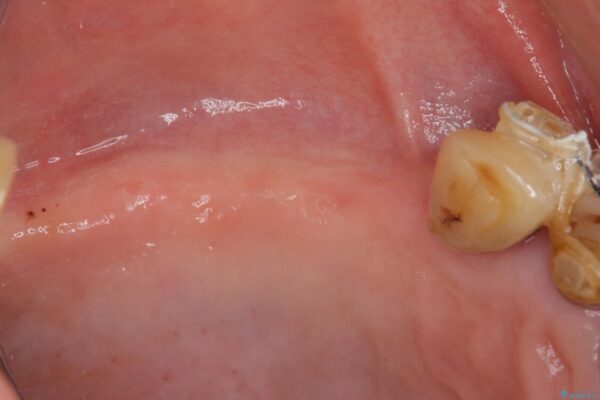 治療途中で放置してしまった前歯　オールセラミッククラウンによる補綴治療 治療前画像