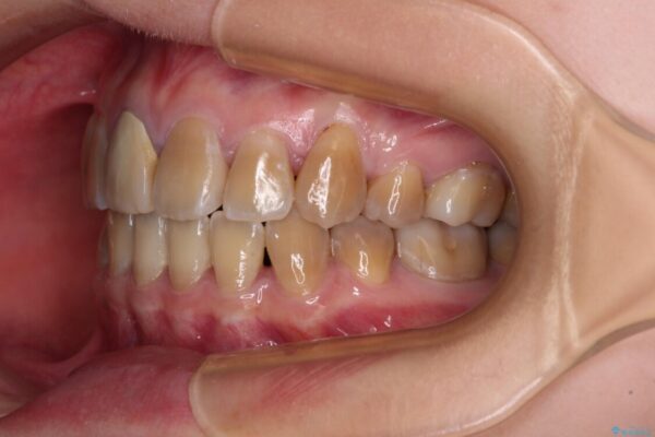八重歯とクロスバイト　目立たないワイヤー装置での抜歯矯正 治療後画像