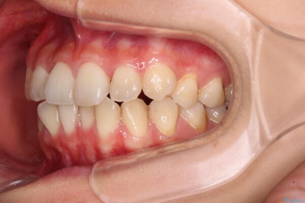 前歯のクロスバイト　ワイヤー装置を併用したインビザライン矯正 治療途中画像