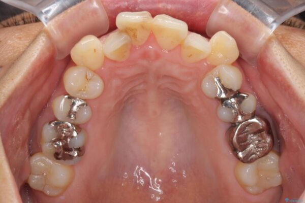 八重歯で口元が膨れている　ワイヤー装置での抜歯矯正 治療前画像