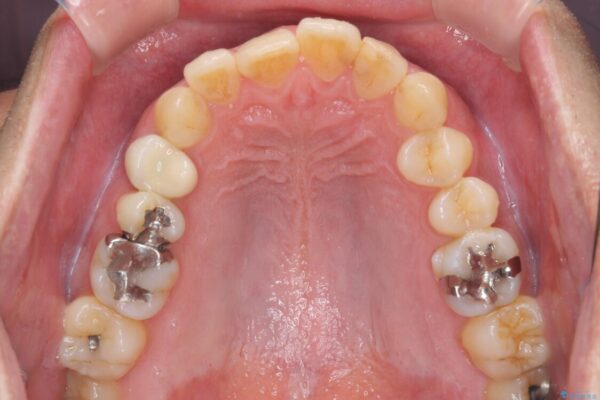 外側に飛び出した歯　インビザラインによる矯正治療 治療前画像