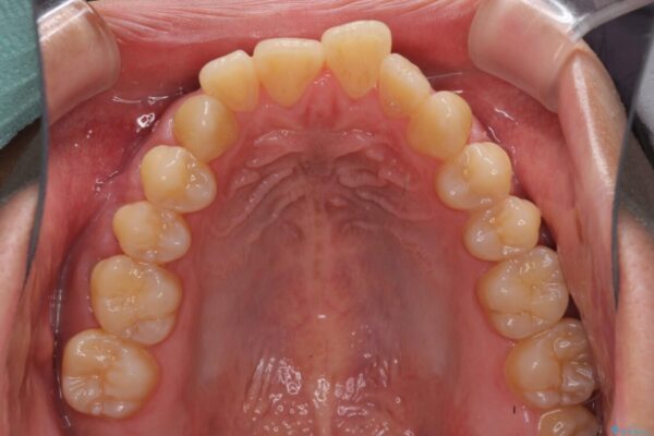 隙間が空いて突出した前歯を治したい　ワイヤー装置による抜歯矯正 治療前画像