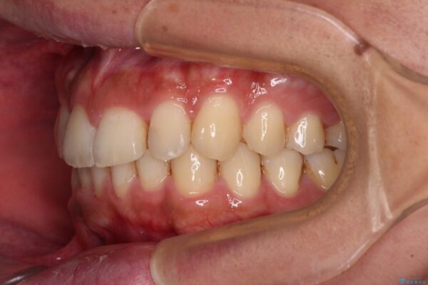 前歯のデコボコをスッキリ改善　インビザライン矯正 治療後画像