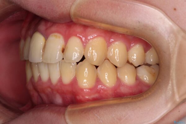 前歯のデコボコを治したい　インビザライン矯正治療 治療後画像