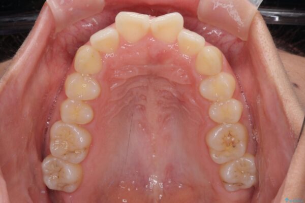 前歯の出っ歯と口の閉じにくさが気になる　目立たないワイヤー装置での抜歯矯正 治療前画像