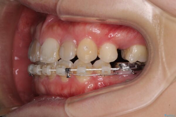 八重歯と開咬を治したい　目立たないハーフリンガル矯正 治療途中画像