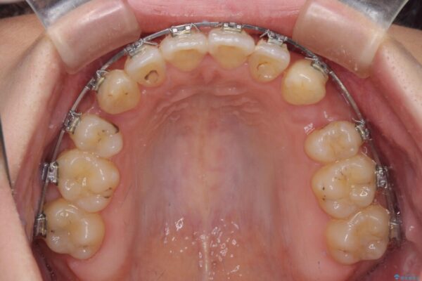 八重歯を抜歯矯正でスッキリと　メタルブラケットでの矯正治療 治療途中画像