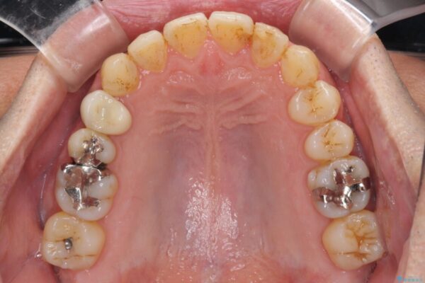 外側に飛び出した歯　インビザラインによる矯正治療 治療途中画像