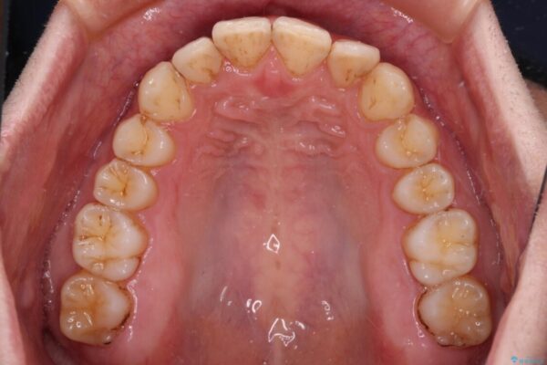 前歯のデコボコをスッキリ改善　インビザライン矯正 治療途中画像