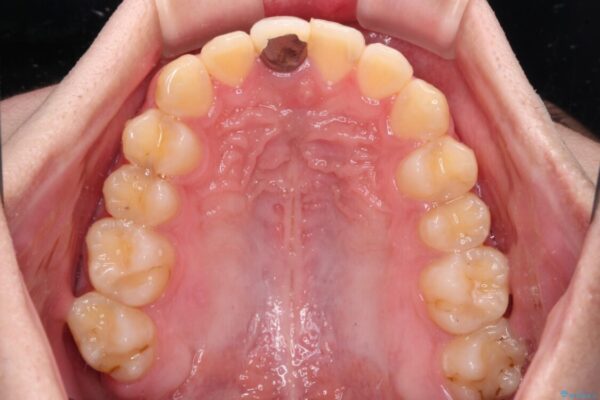 前歯のデコボコを治したい　インビザライン矯正治療 治療途中画像