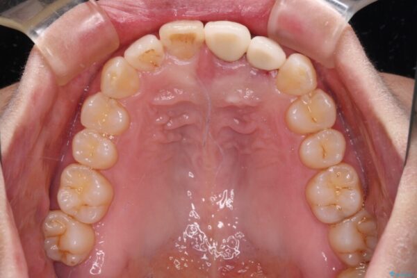 前歯のインプラント治療　折角なので矯正治療できれいな歯並びに 治療途中画像