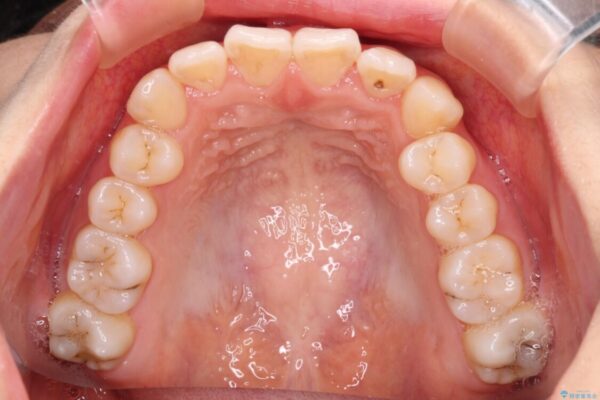 前歯のクロスバイト　ワイヤー装置を併用したインビザライン矯正 治療途中画像