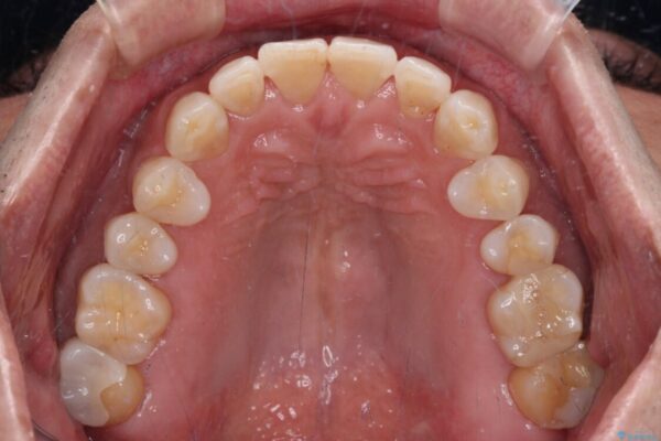 内側にある歯が干渉する　上顎前歯の部分矯正 治療後画像