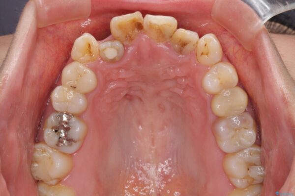 八重歯と開咬を治したい　目立たないハーフリンガル矯正 治療前画像