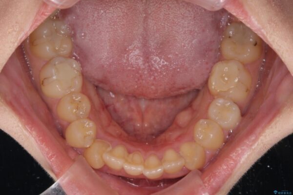 八重歯を抜歯矯正でスッキリと　メタルブラケットでの矯正治療 治療前画像
