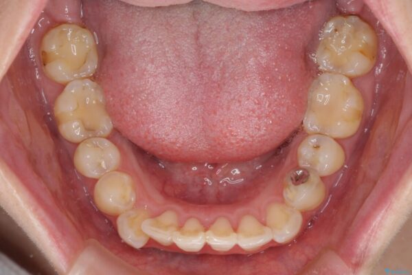 出っ歯による口の閉じにくさを治したい　ワイヤー装置を用いた抜歯矯正 治療前画像