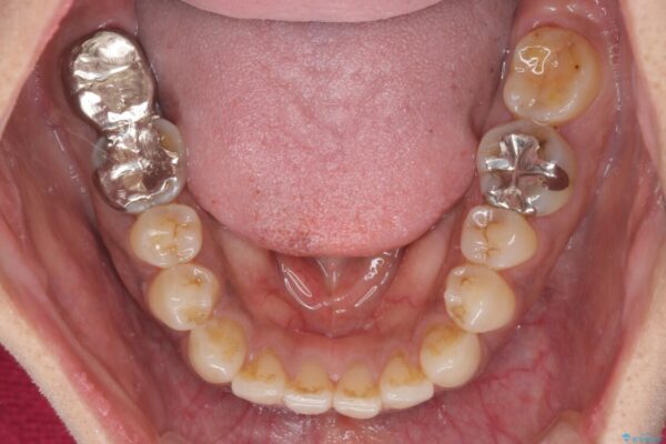 極端な上下前歯の開咬を改善　オープンバイトのインビザライン矯正 治療前画像
