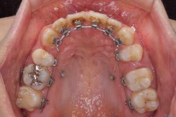 八重歯と開咬を治したい　目立たないハーフリンガル矯正 治療途中画像