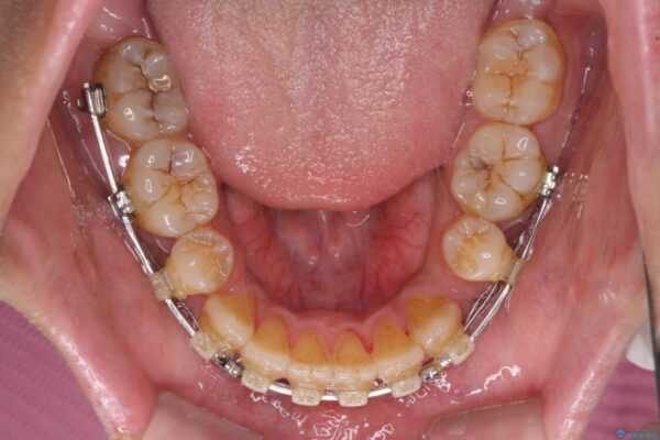 隙間が空いて突出した前歯を治したい　ワイヤー装置による抜歯矯正 治療途中画像