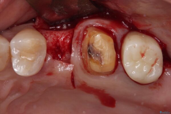 治療後に歯茎から出血　インプラントとオールセラミッククラウンの補綴治療 治療前画像