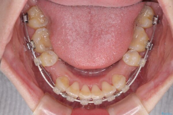 出っ歯による口の閉じにくさを治したい　ワイヤー装置を用いた抜歯矯正 治療途中画像