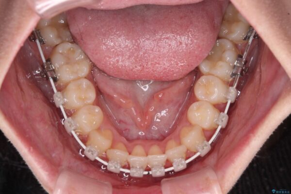 前歯のクロスバイトを短期間で解消　目立たないワイヤー矯正 治療途中画像