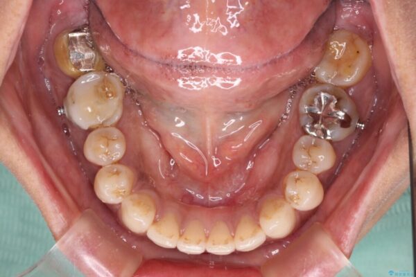 極端な上下前歯の開咬を改善　オープンバイトのインビザライン矯正 治療途中画像