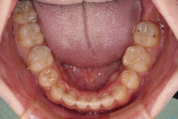 八重歯を抜歯矯正でスッキリと　メタルブラケットでの矯正治療 治療後画像