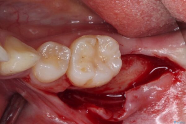 部分矯正を併用した奥歯のインプラント治療 治療前画像