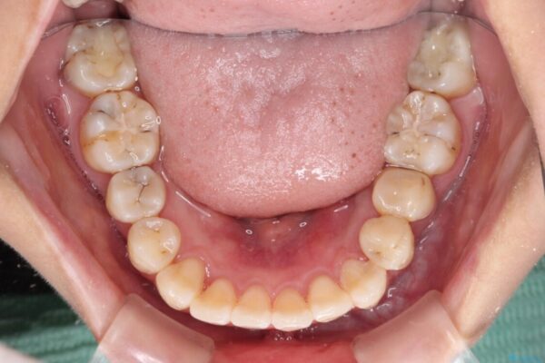 デコボコで磨きにくい前歯をスッキリと　インビザライン矯正 治療途中画像